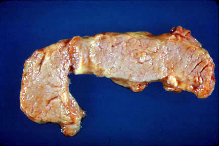 Normal Pancreas